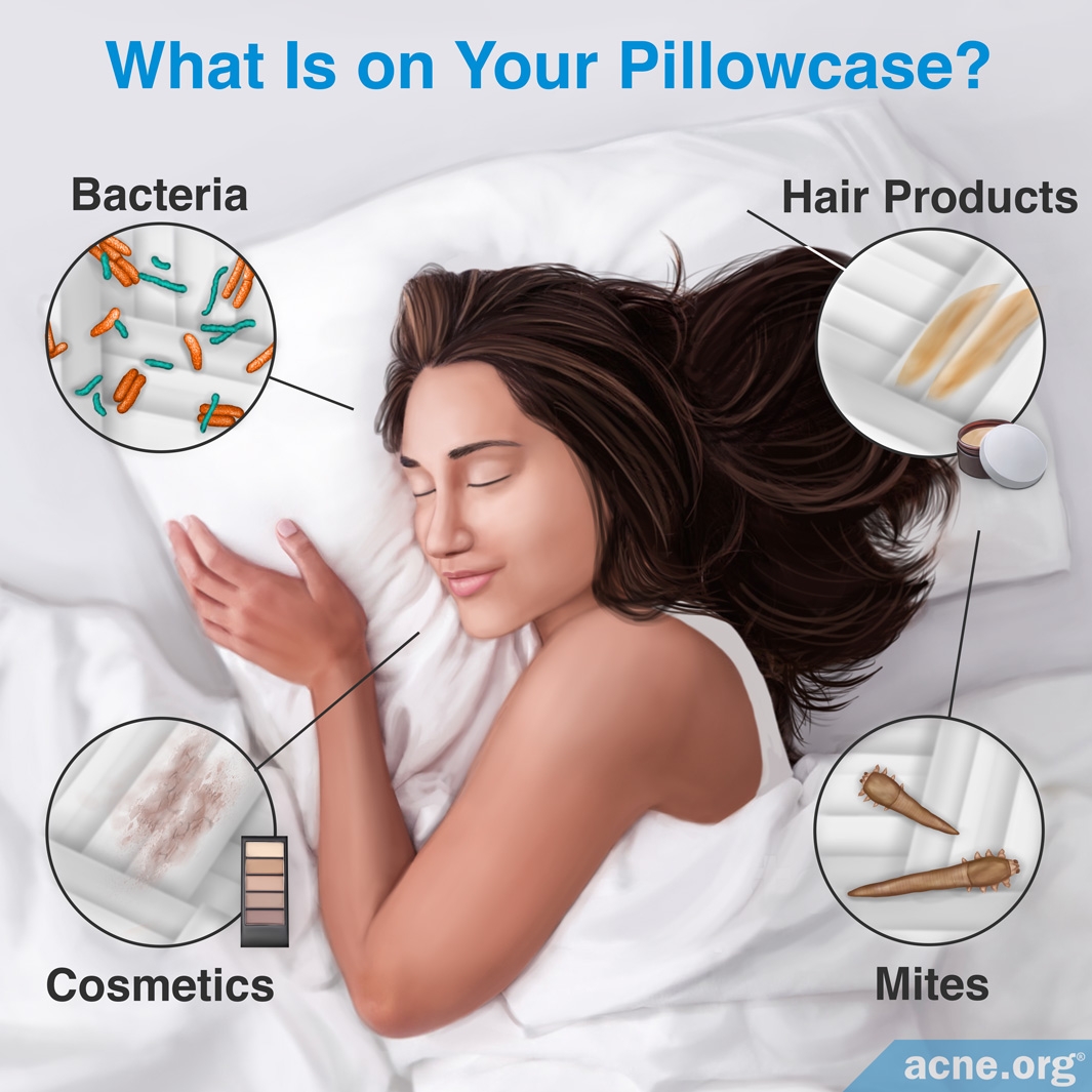 How Often Should an Acne-prone Person Change His/Her Pillowcase? - Acne.org