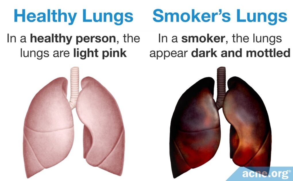 Does Smoking Cigarettes Cause Acne? - Acne.org