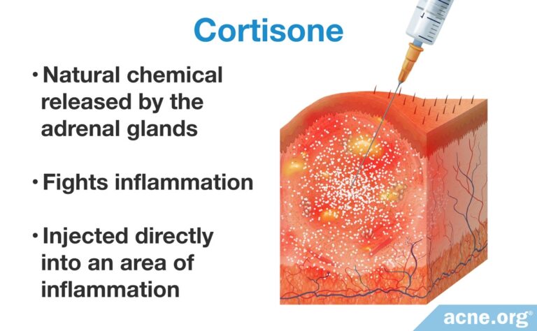 Cortisone Shots For Acne - Acne.org