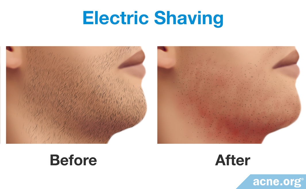 Is Shaving Good or Bad for Acne? - Acne.org