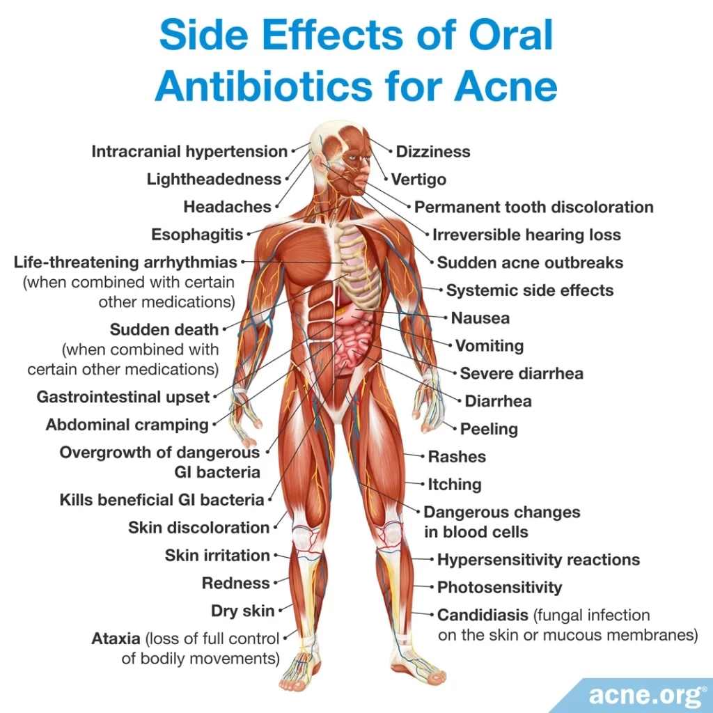 Side Effects of Oral Antibiotics for Acne