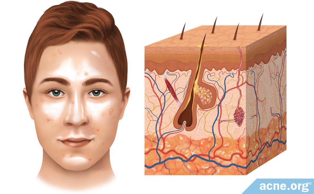 The Role of Sebum (Skin Oil) in Acne - Acne.org