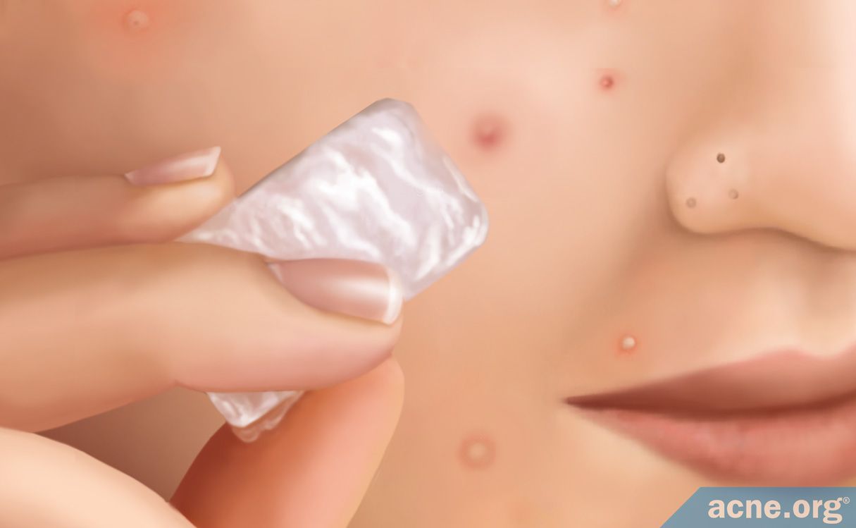 Does Ice Help to Heal Acne? - Acne.org