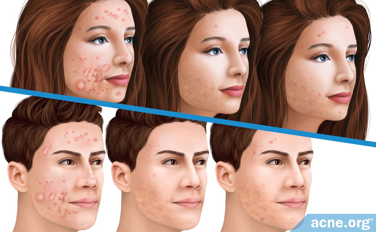 What Is the Actual Relapse Rate of Accutane (isotretinoin)? - Acne.org