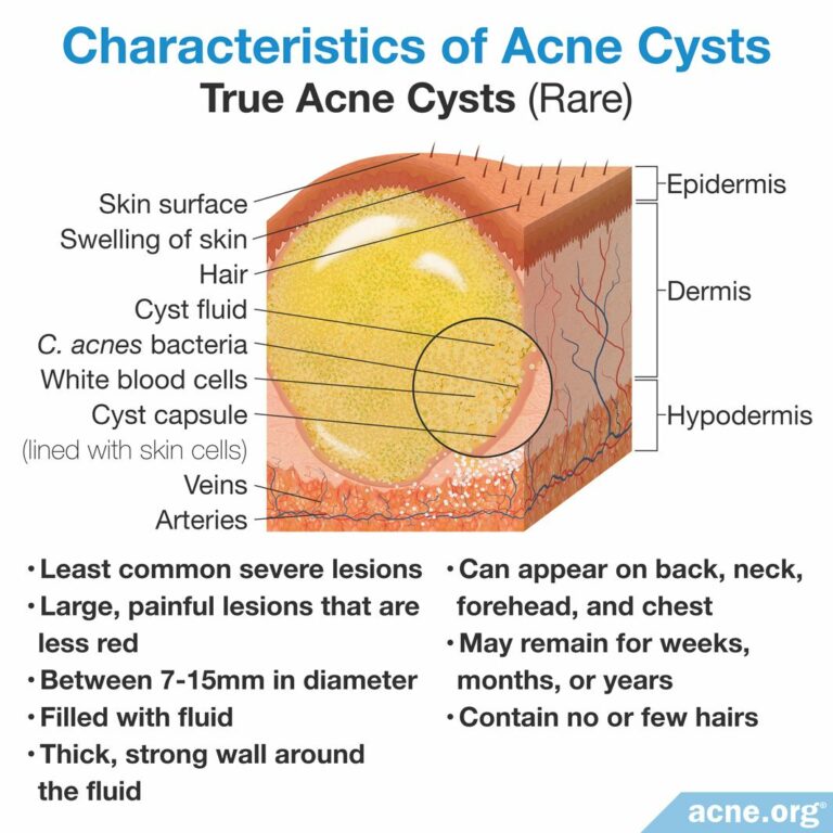 what-is-an-acne-cyst-acne