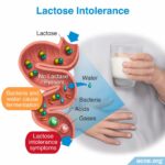 Does Lactose Intolerance Relate To Acne? - Acne.org