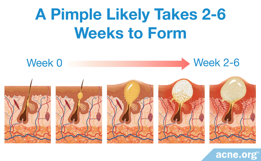 How Long Does It Take for a Pimple to Form? - Acne.org