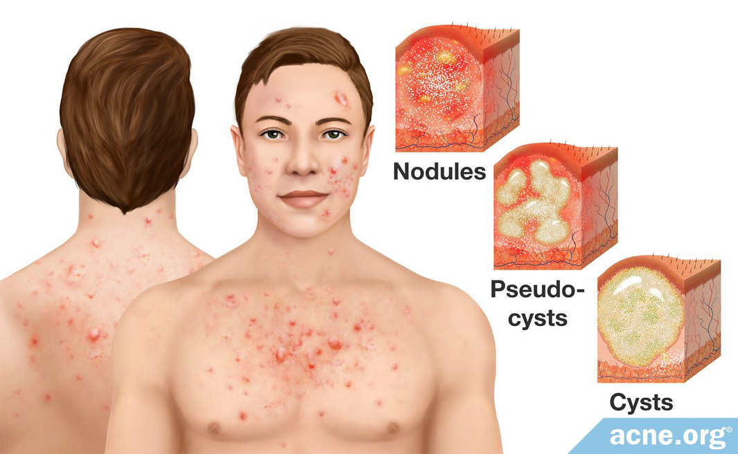 Cystic Acne on the Body - Acne.org