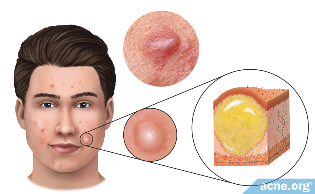 What Is an Acne Cyst? - Acne.org