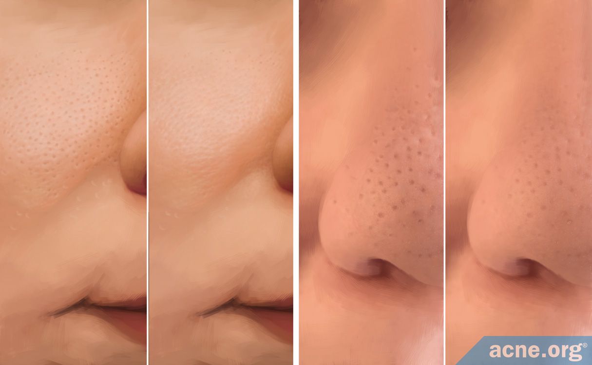 Can You Reduce the Size of Your Skin Pores? - Acne.org