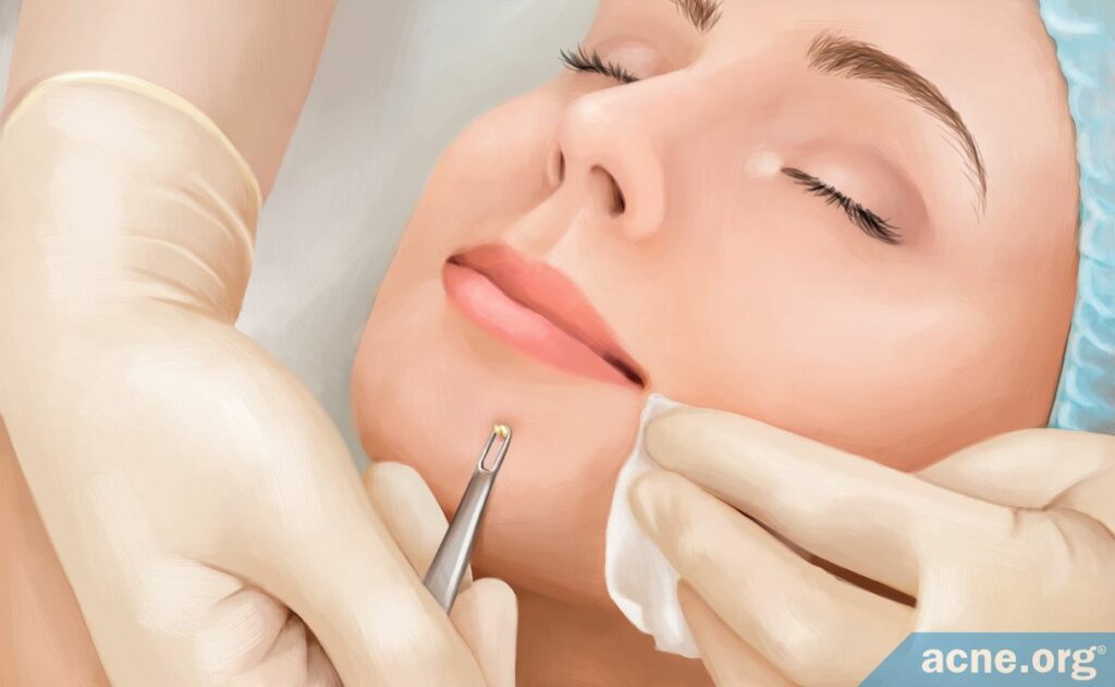 What Is Comedone Extraction And Should You Do It Acne