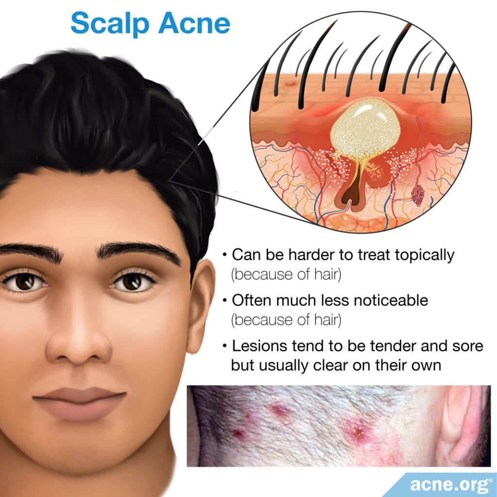 Scalp Acne Acne