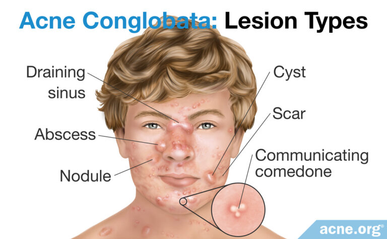 What Is Acne Conglobata? - Acne.org