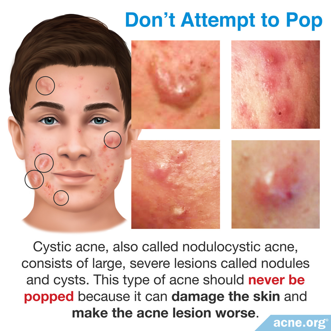 Should You Pop Cystic Acne? - Acne.org