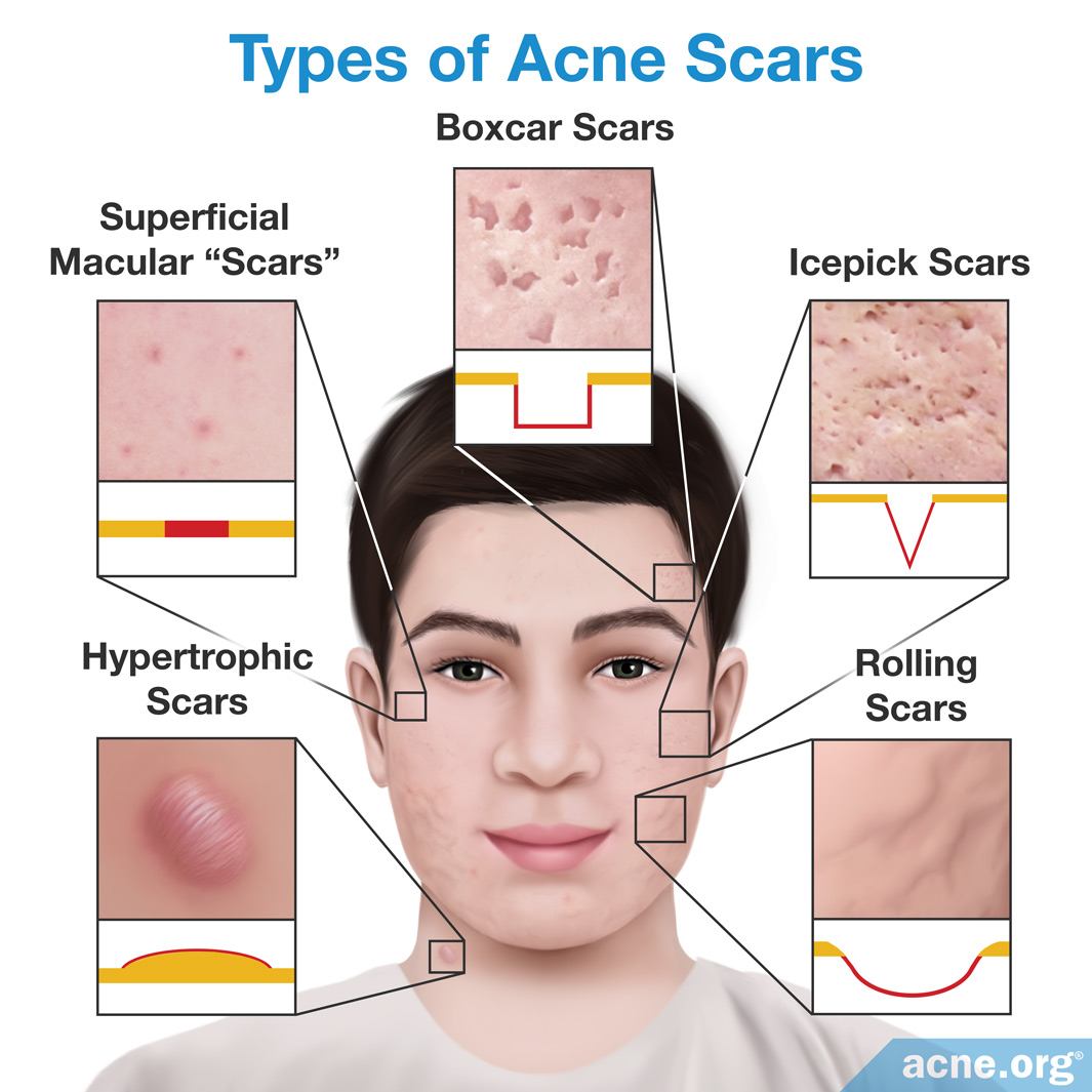 What Causes A Pimple To Scar Acne