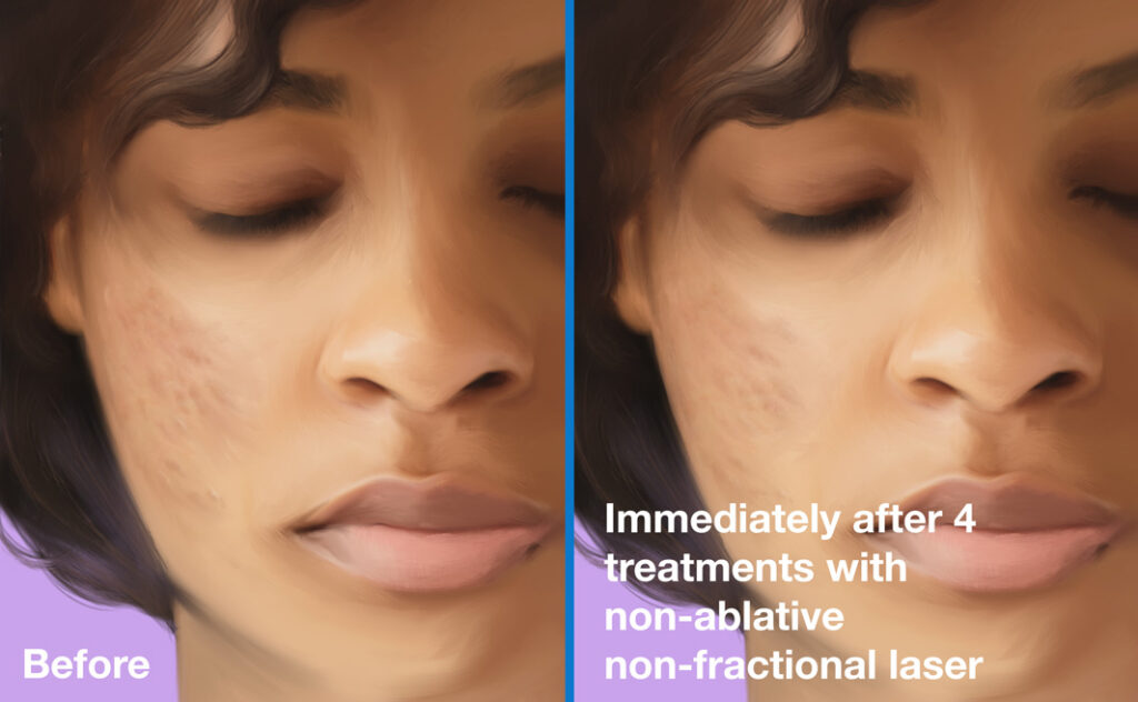 Non-Ablative-Non-Fractional-Before-and-After