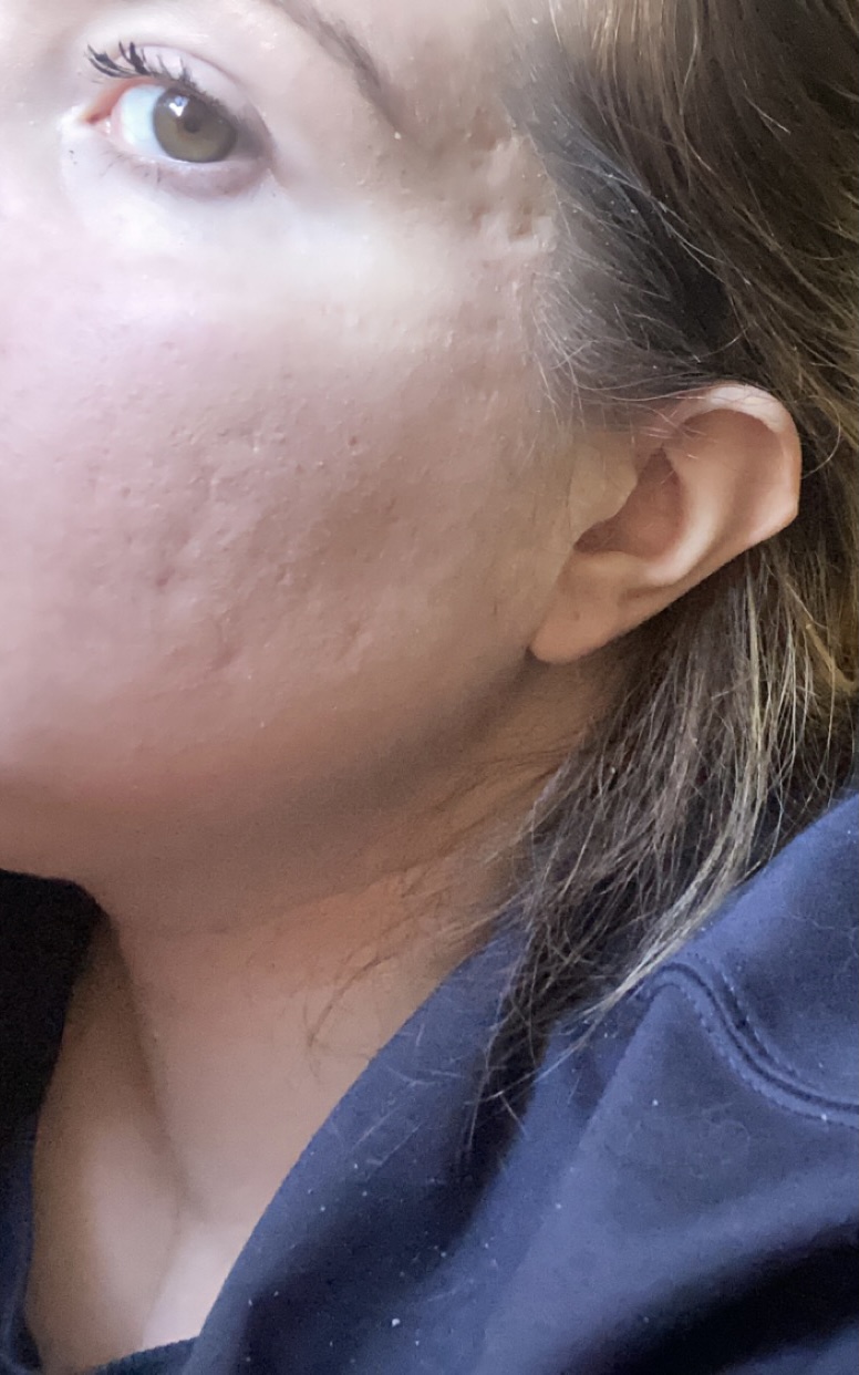 Co2 Laser for these scars? – Scar treatments – Acne.org Forum